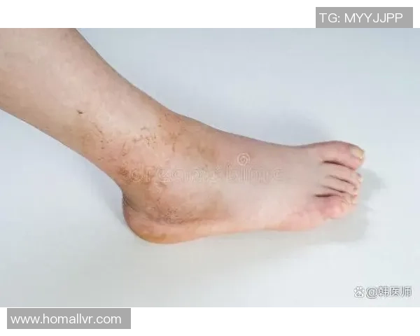 脚踝伤势对足球运动员的影响及恢复训练方法探讨